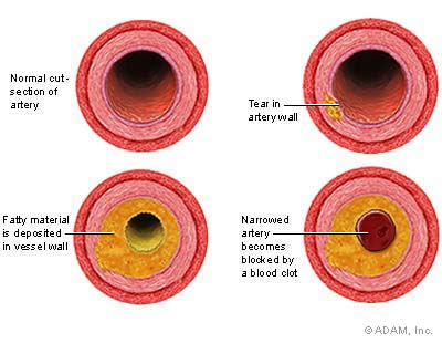 Artery pathology