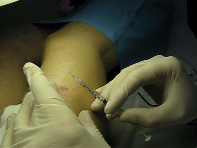 sclerotherapy1